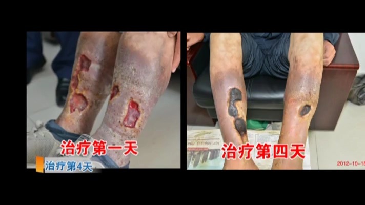 劉希山救助靜脈炎潰爛21年小伙紀實